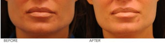 Botox Jaw Reduction