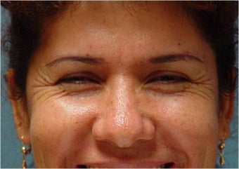Botox Crow's feet