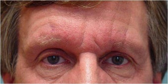 Botox frown lines