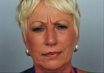Botox Injection