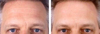 Botox Cosmetic