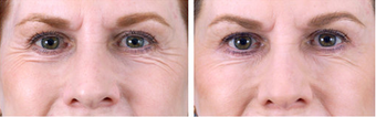 Botox Cosmetic