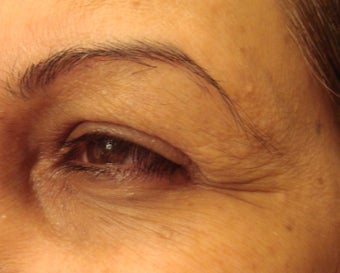 botox injections