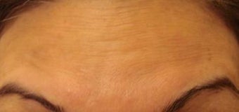 botox injections