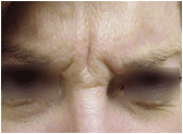 Botox