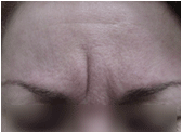 Botox