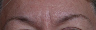Botox