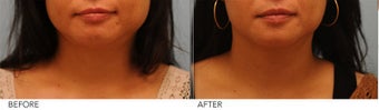 Botox Jaw Reduction