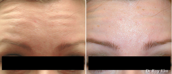 Botox