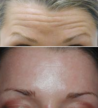 Botox