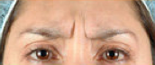 BOTOX 