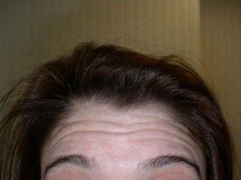 Botox