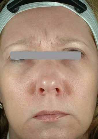 Botox