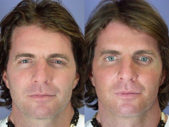 Botox