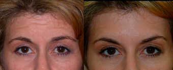 Botox 