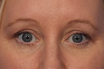 Botox to Crows Feet and Between Eyes (Glabella)