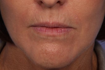 Botox and Juvederm Ultra Plus to Upper Lip
