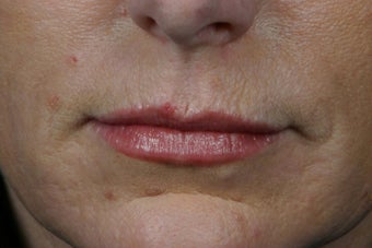 Botox 
