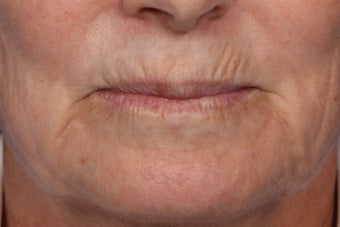 Botox and Juvederm 