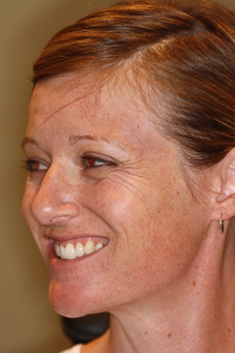 Botox / Dysport