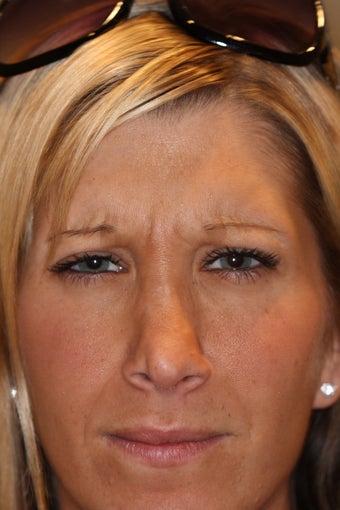 Botox Injection