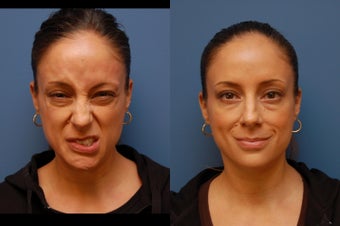 Botox for facial paralysis