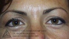 Botox to Glabella (Frown Lines)