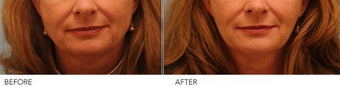 Botox Jaw (masseter) reduction