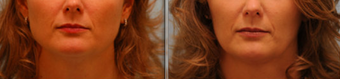 Botox Jaw (masseter) reduction