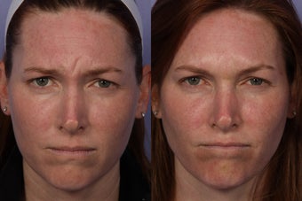 Botox