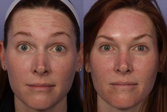 Botox to Forehead