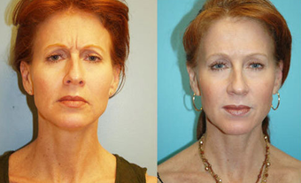 Botox