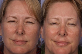 Botox to Crows Feet