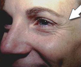 Botox Cosmetic - Crow's Feet