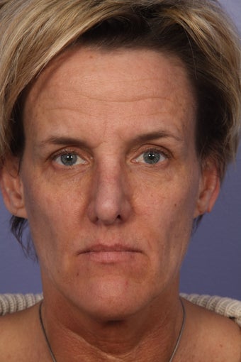 Botox 
