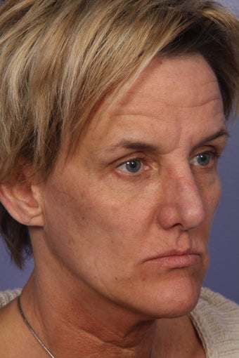 Botox 
