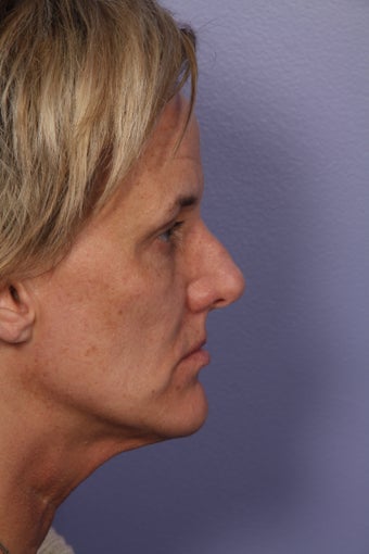 Botox 