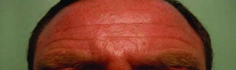 BOTOX in the forehead