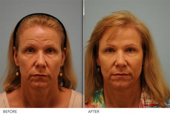 Short Term Botox