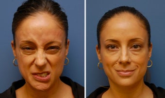 Botox for Synkinesis, Bell's Palsy, Facial Paralysis