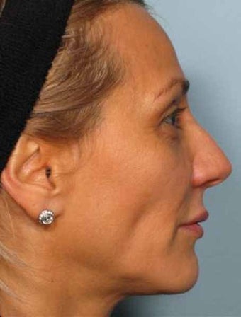 BOTOX combined with Radiesse
