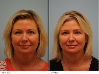 Short Term Botox