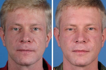 Radiesse, Restylane, Juvederm Plus & Botox Cosmetic
