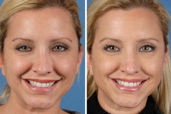 Botox Cosmetic & Restylane