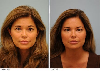 Botox 
