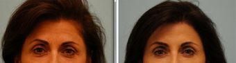 Botox