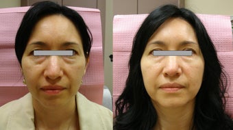Botox Cosmetic