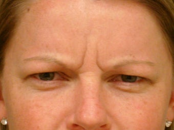 Botox Cosmetic