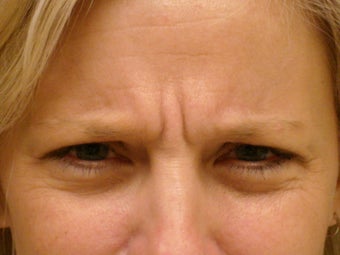 Botox Cosmetic