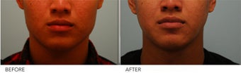 Botox Jaw Reduction